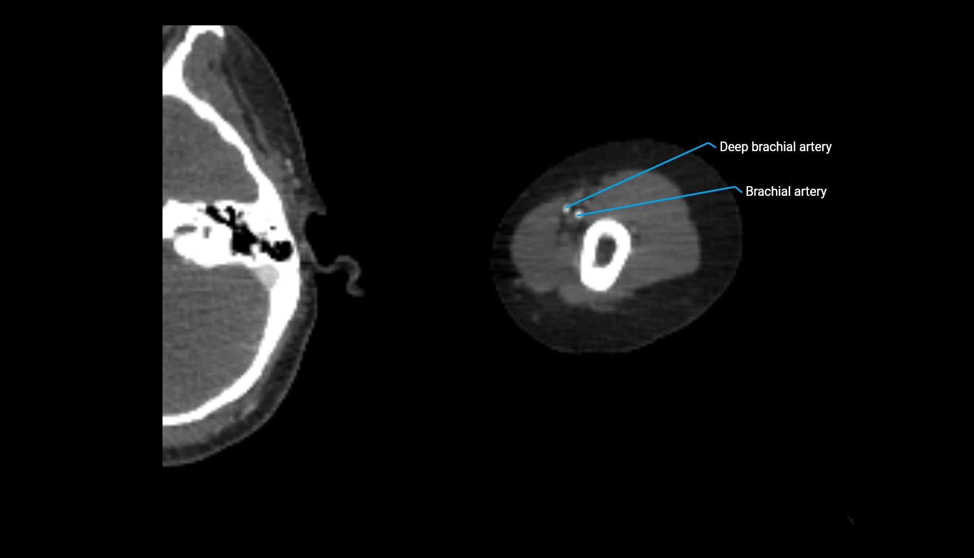 CTA upper limb axial cross sectional anatomy labelled image 261 (2).webp